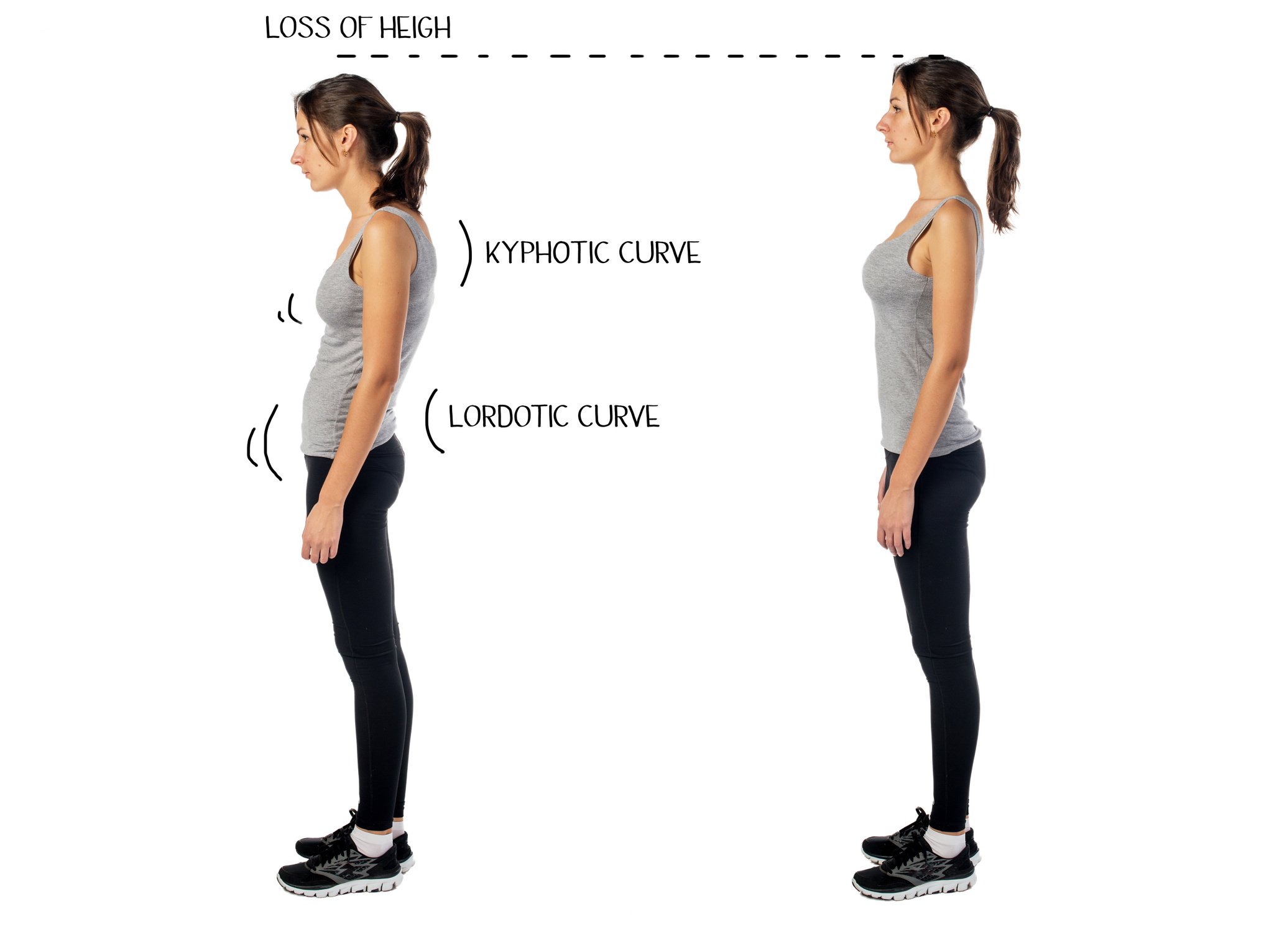 Woman with impaired posture position defect scoliosis and ideal bearing